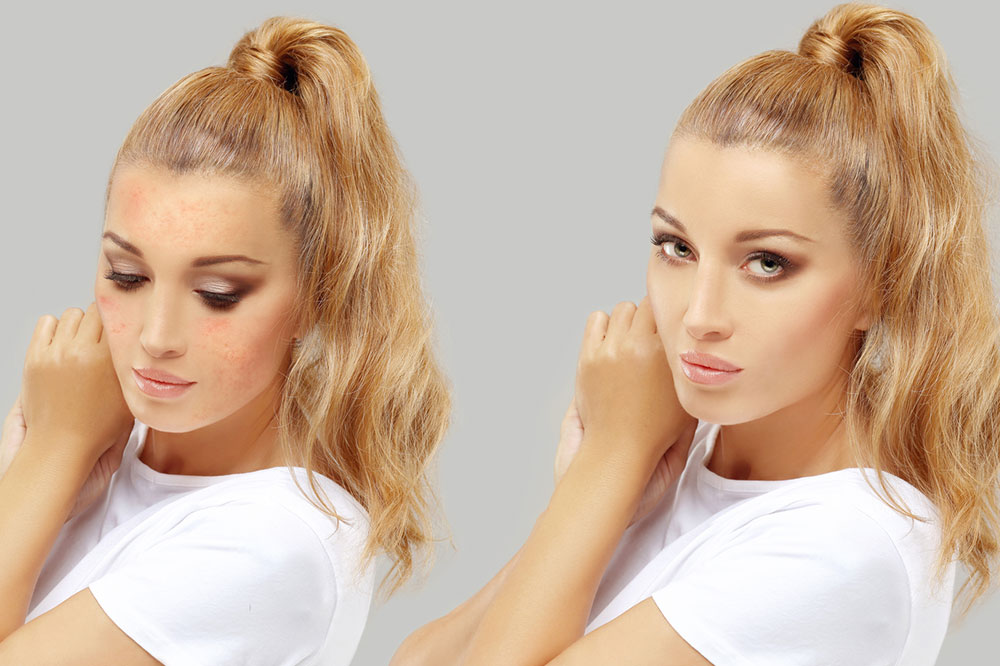 Types of Plastic Surgeries to Treat Scars