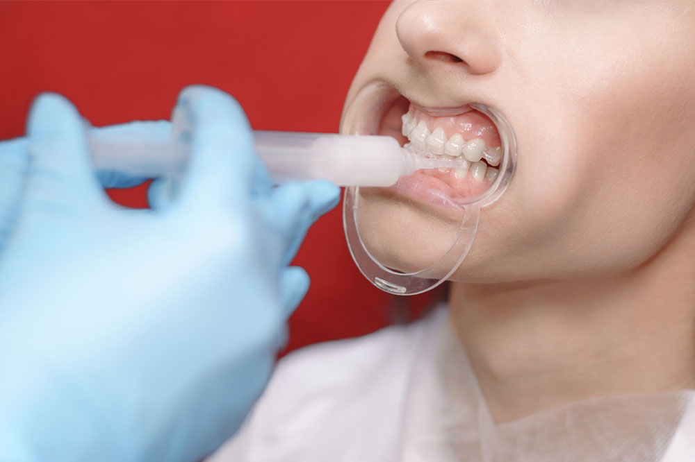 A Handy Guide on Whitening Gels